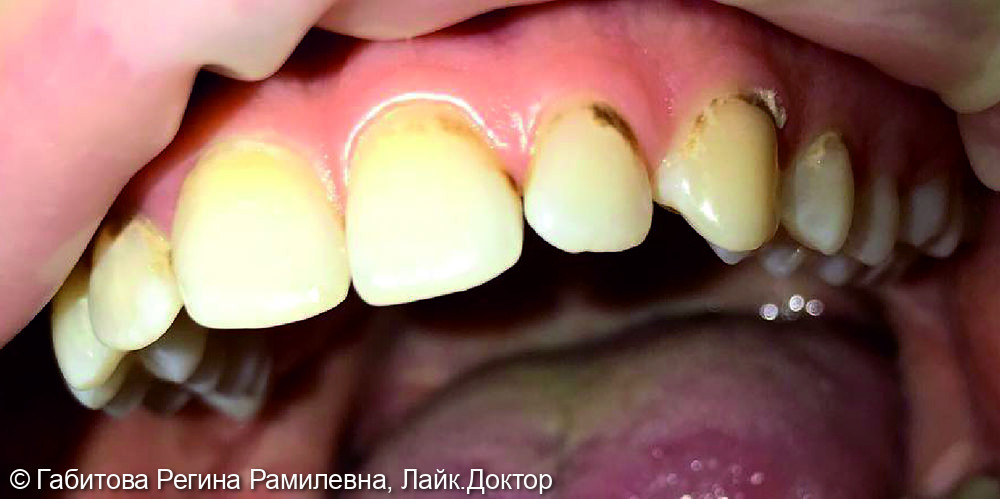 Устранение пришеечного кариеса на 22 и 23 зубах - фото №1