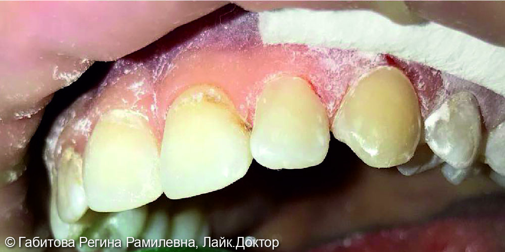Устранение пришеечного кариеса на 22 и 23 зубах - фото №2