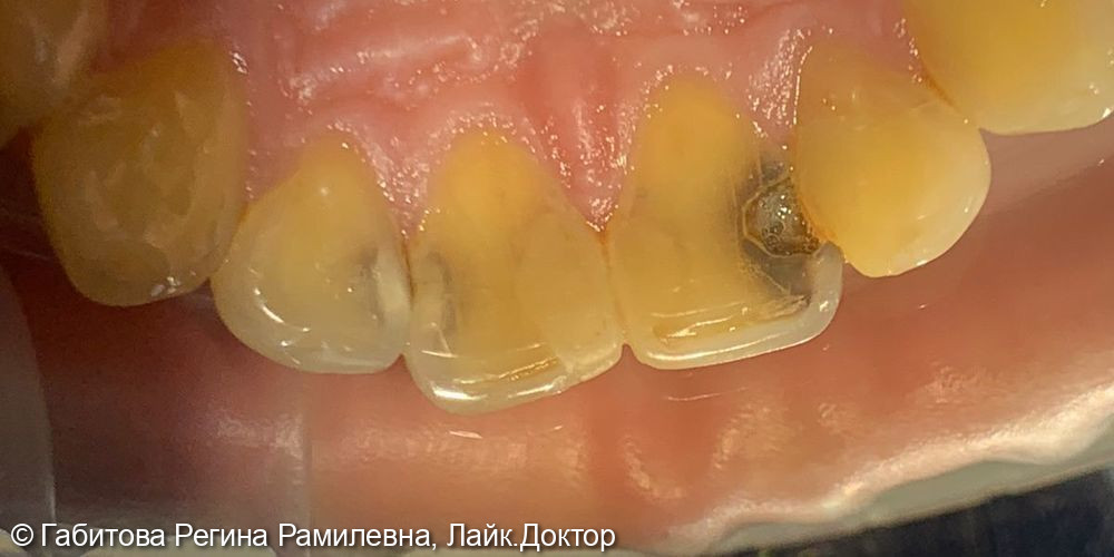 Лечение кариеса передних зубов - фото №1
