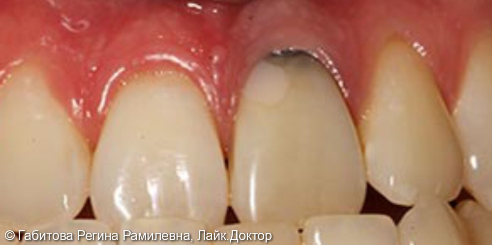 Лечение кариеса переднего зуба - фото №1