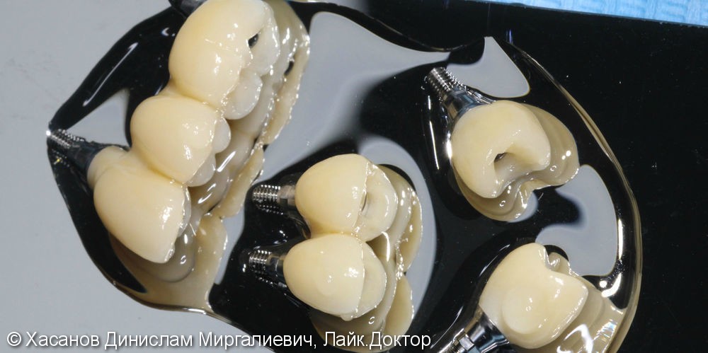 Протезирование на имплантах фото 3 · Уфа