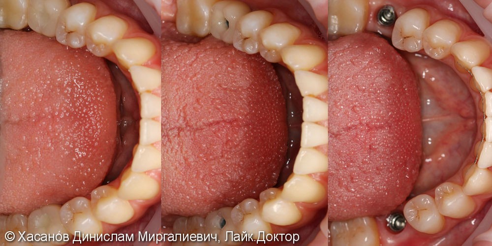 Ортодонтическая коррекция прикуса, имплантация зубов - фото №1