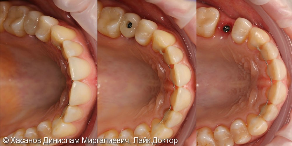 Ортодонтическая коррекция прикуса, имплантация зубов - фото №2