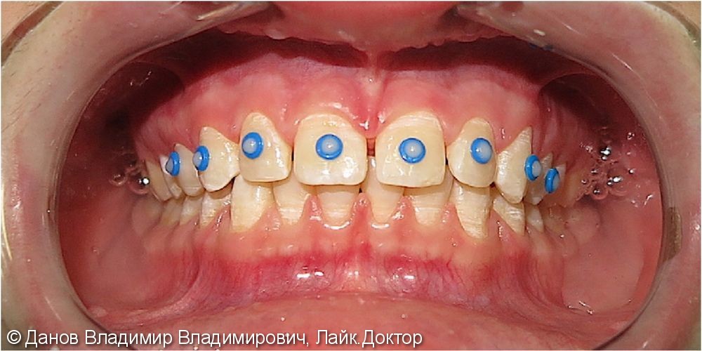 Закрытие трем (промежутков между зубами), до и после - фото №1