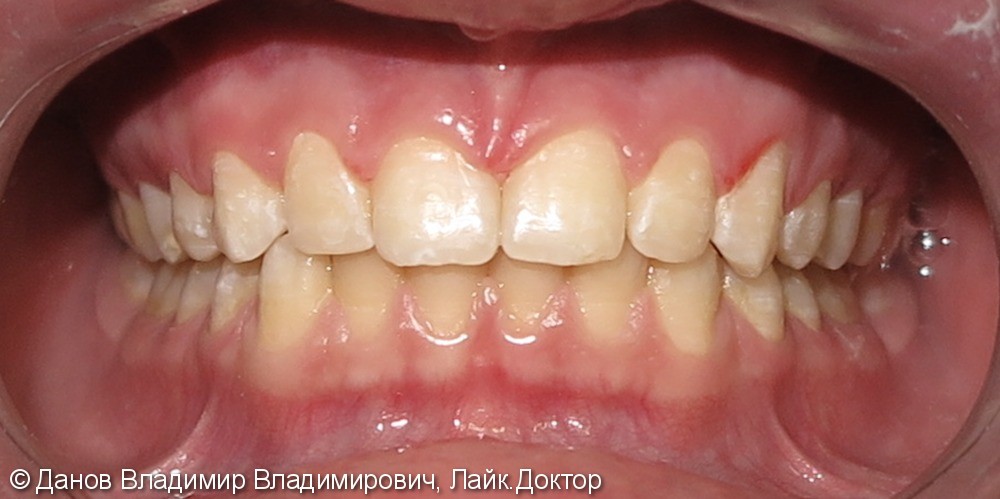 Закрытие трем (промежутков между зубами), до и после - фото №3
