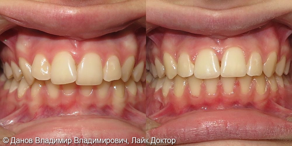 лечение дистального прикуса фото 3 · Тула