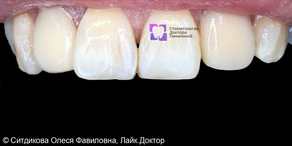 Люминирование или художественная реставрация зубов материалом Enamel Plus - фото №2