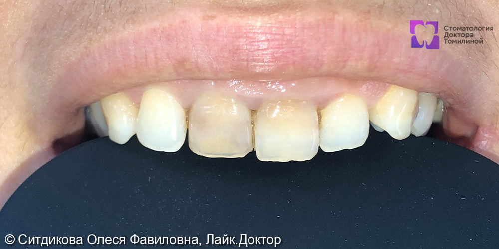 Реставрация передних зубов - фото №1