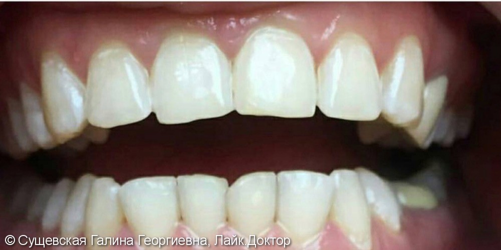Отбеливание зубов по американской системе Amaizing White - фото №2