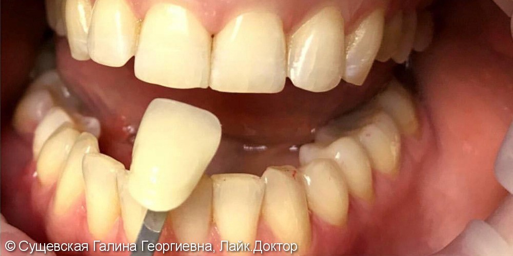 Отбеливание зубов по американской системе Amaizing White - фото №1