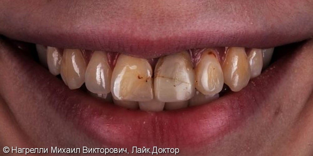 Протезирование зубов коронками Emax и керамическими винирами - фото №1