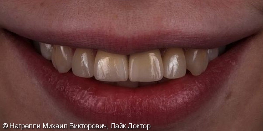 Протезирование зубов коронками Emax и керамическими винирами - фото №2