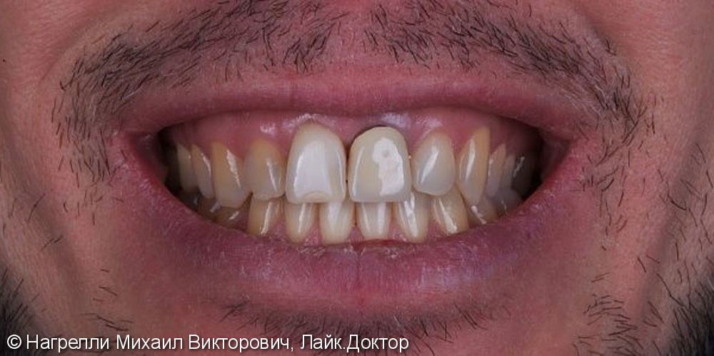 Цельнокерамические коронки на передние зубы, до и после - фото №1