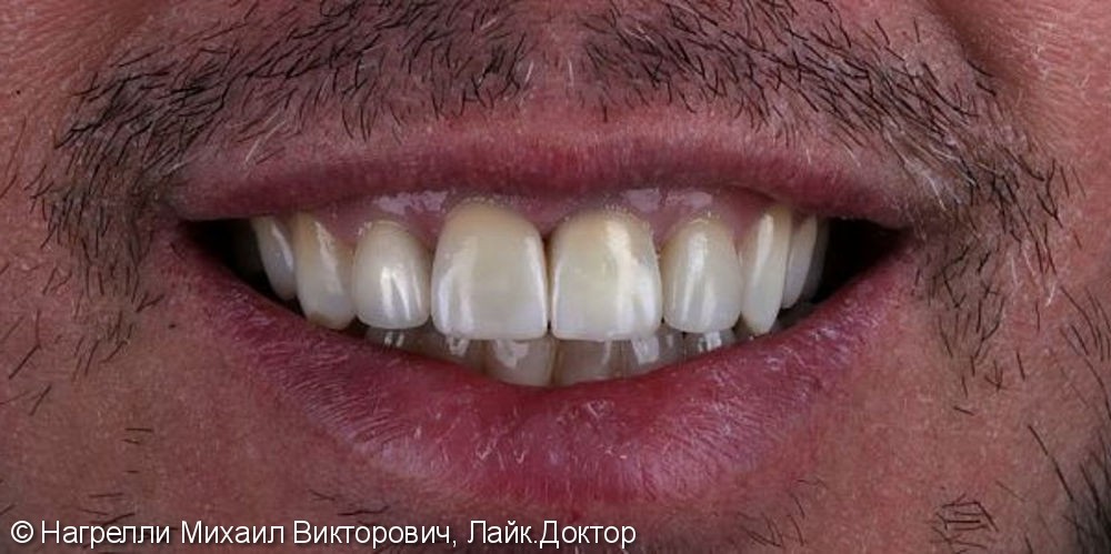 Цельнокерамические коронки на передние зубы, до и после - фото №2