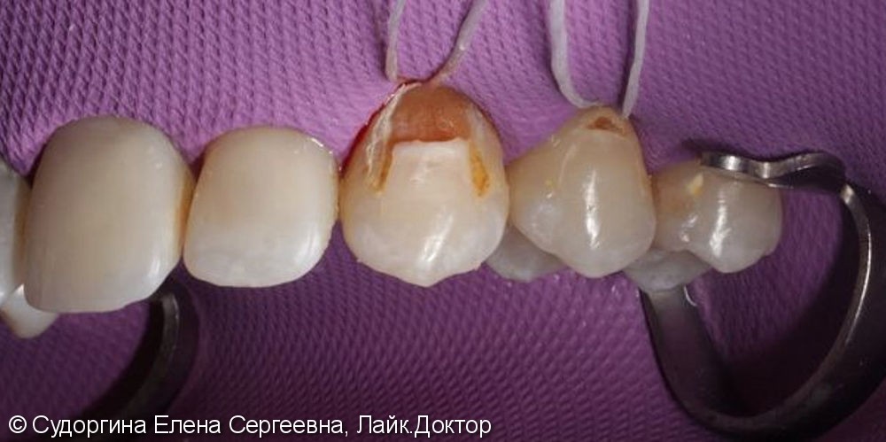 Лечение кариеса на верхней шейке зуба - фото №1