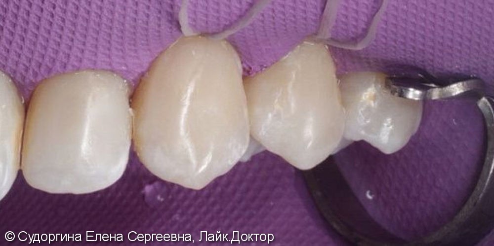 Лечение кариеса на верхней шейке зуба - фото №2