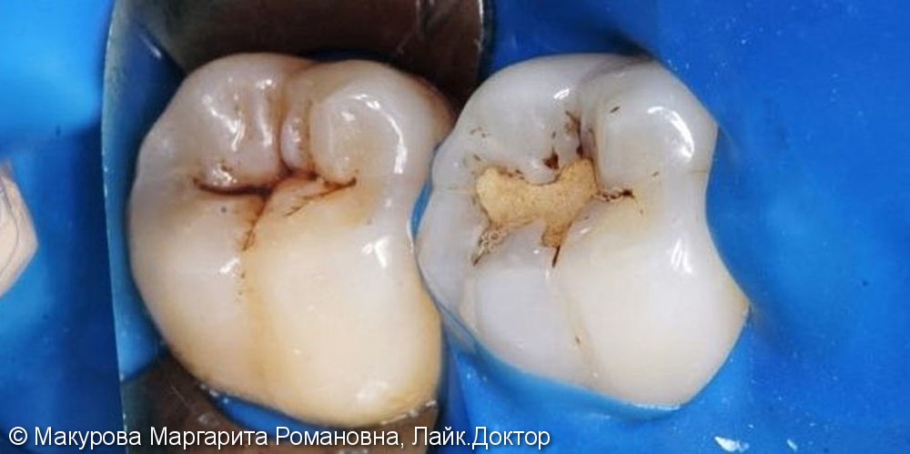 Лечение кариеса 2х жевательных зубов за одно посещение - фото №1