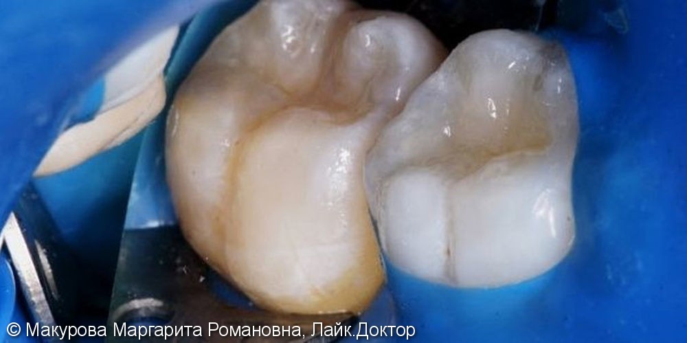 Лечение кариеса 2х жевательных зубов за одно посещение - фото №2