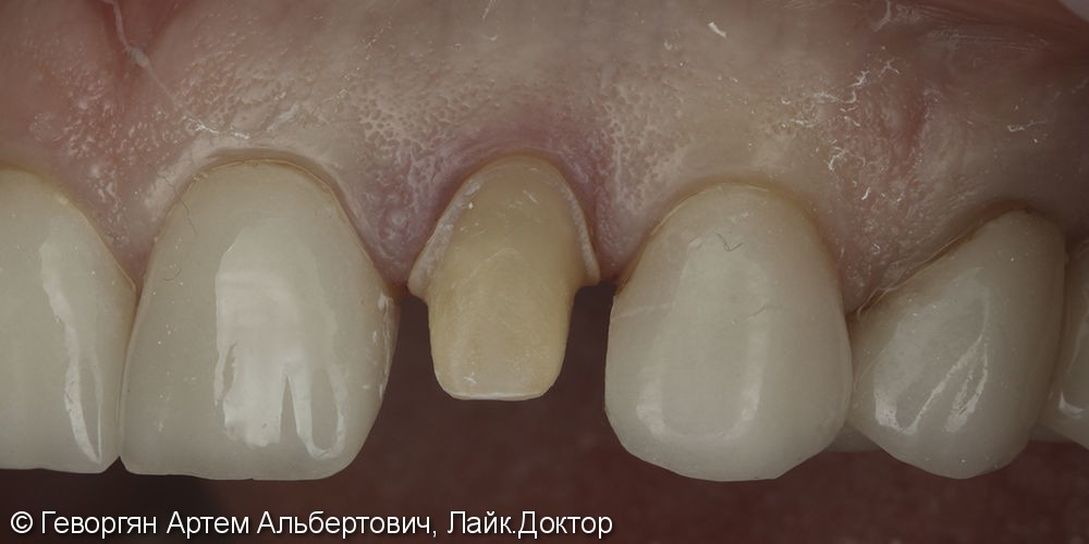 Восстановление бокового резца цельнокерамической коронкой (E.max) - фото №1