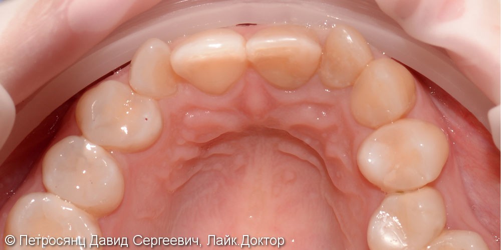 Изготовление цельно-керамических коронок и виниров, до и после - фото №2
