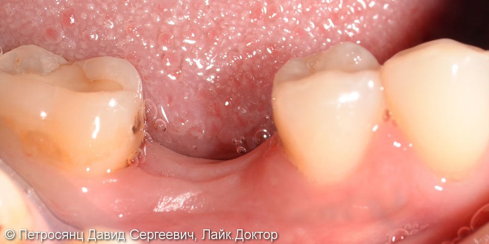 Постановка имплантата на месте утраченного зуба нижней челюсти - фото №1