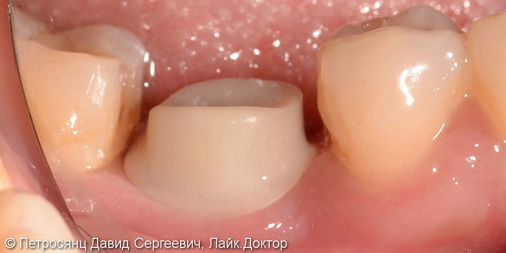 Постановка имплантата на месте утраченного зуба нижней челюсти - фото №2