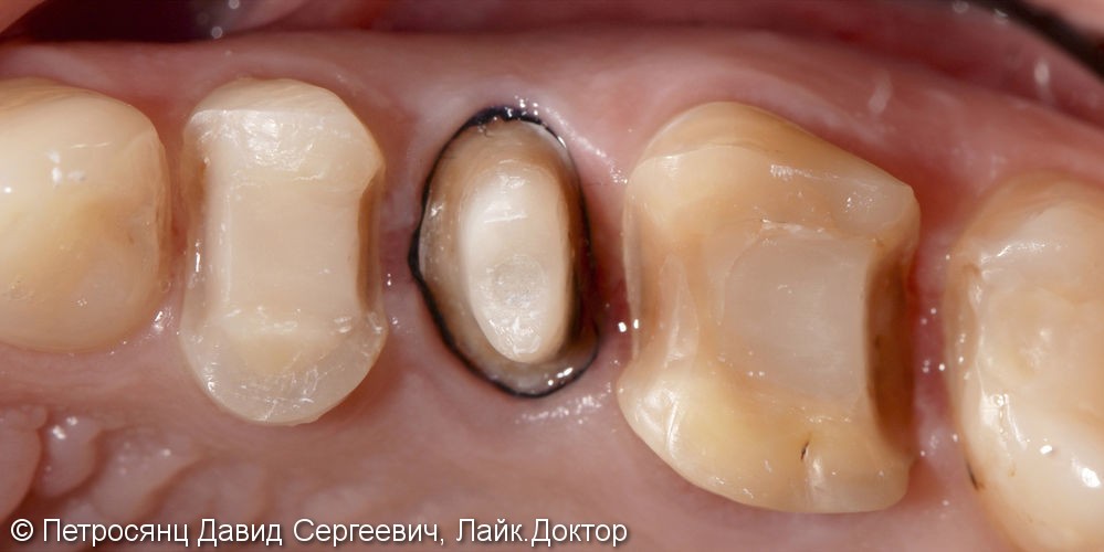 Восстановление зубов керамическими накладками и коронкой - фото №2