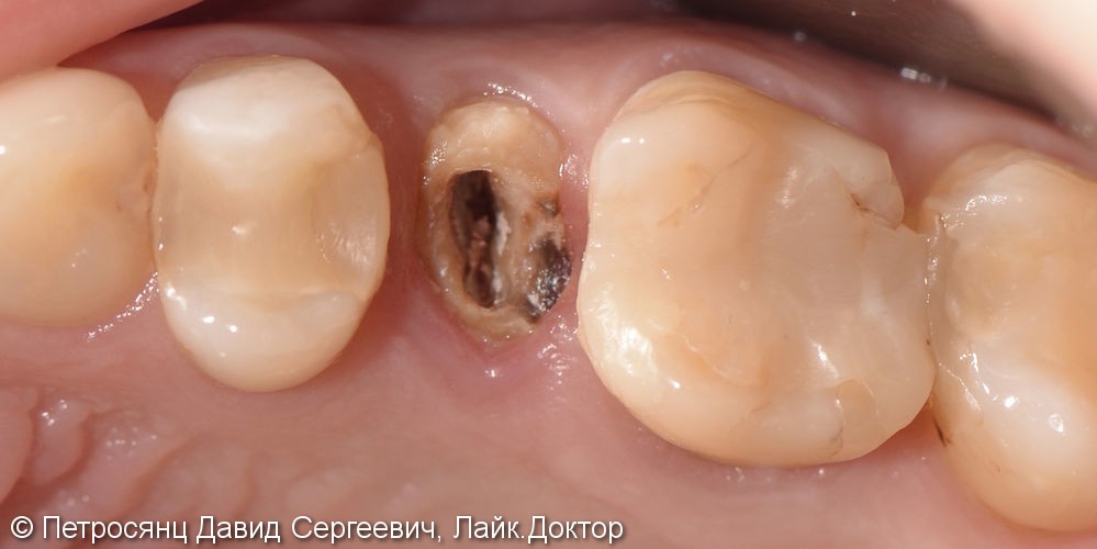 Восстановление зубов керамическими накладками и коронкой - фото №1