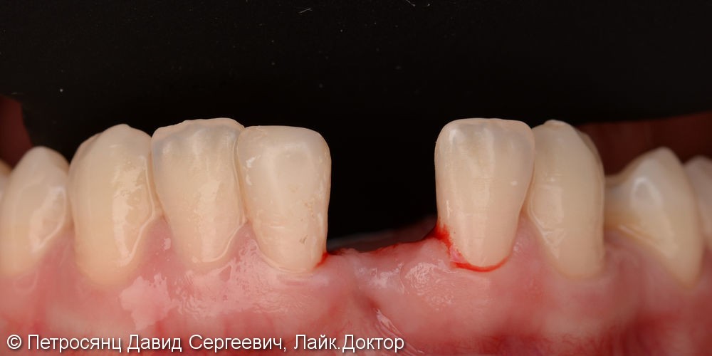 Имплантат на замену утраченного нижнего резца и керамический винир на соседний зуб - фото №1