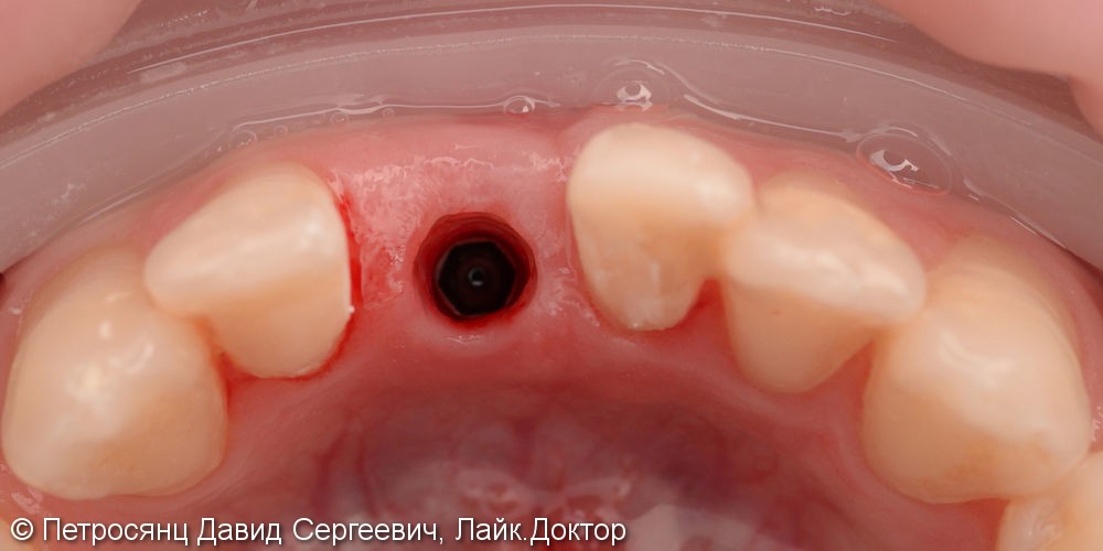Имплантат на замену утраченного нижнего резца и керамический винир на соседний зуб - фото №3
