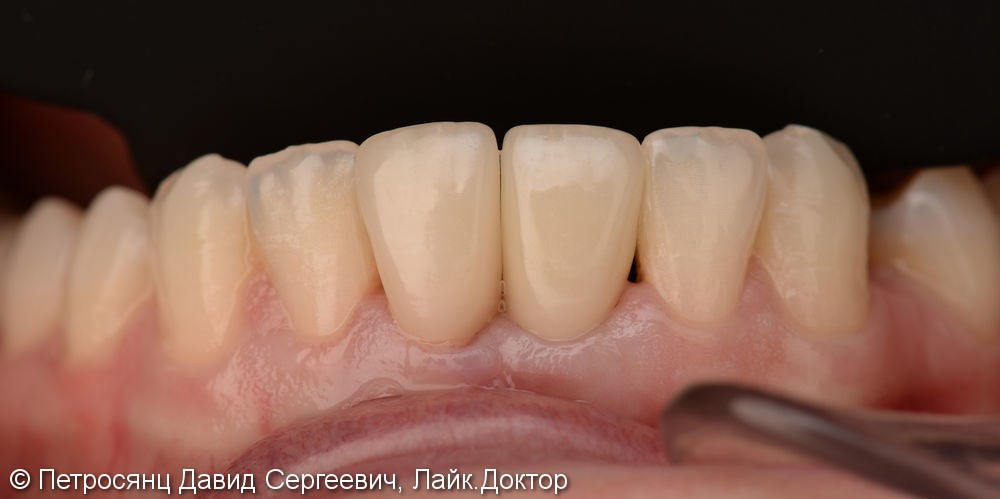 Имплантат на замену утраченного нижнего резца и керамический винир на соседний зуб - фото №6