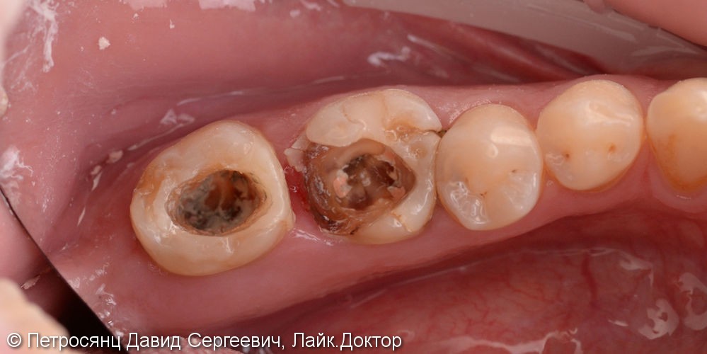 Восстановление зубов цельно-керамическими коронками emax - фото №1