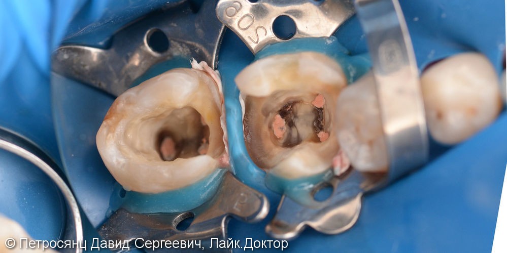 Восстановление зубов цельно-керамическими коронками emax - фото №2