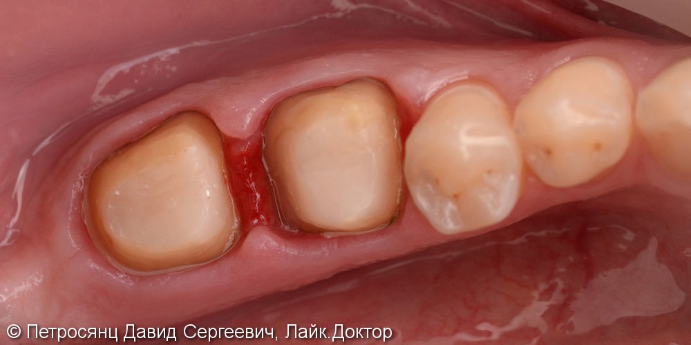 Восстановление зубов цельно-керамическими коронками emax - фото №3
