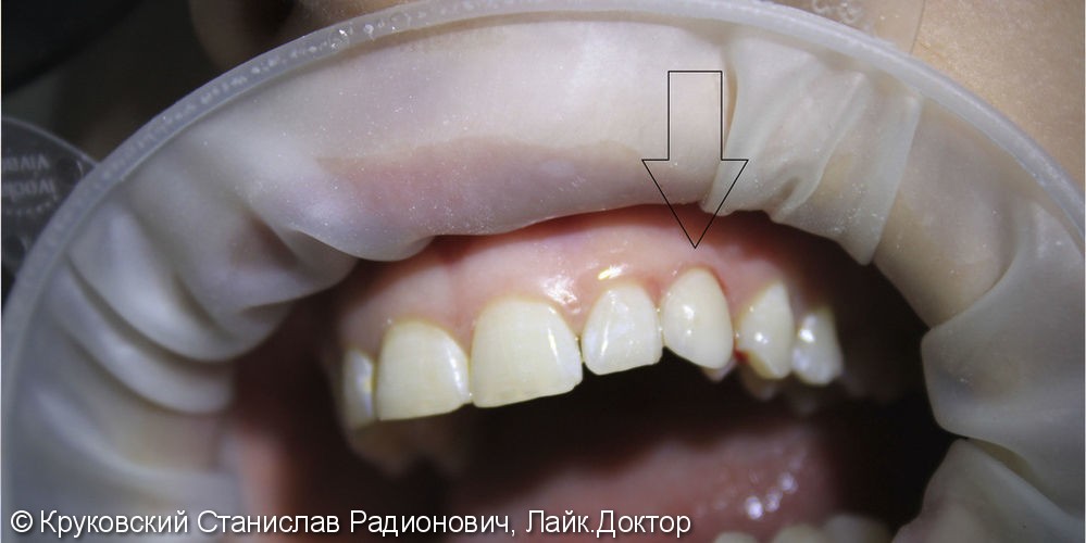 Эстетическая реставрация молочного зуба 63, до и после - фото №2