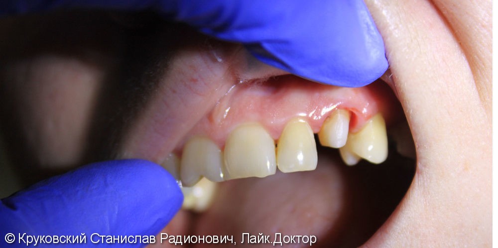Протезирование металлокерамикой зуб 23, до и после - фото №1