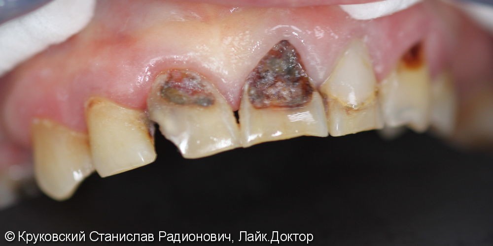 Протезирование металлокерамикой трех зубов подряд 11, 21, 22 - фото №1