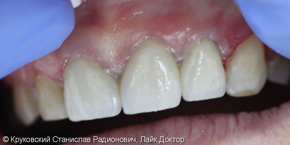 Протезирование металлокерамикой трех зубов подряд 11, 21, 22 - фото №2