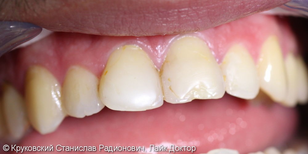 Кариес дентина четырех передних зубов 12, 11, 21, 22 + виниры: до и после - фото №1