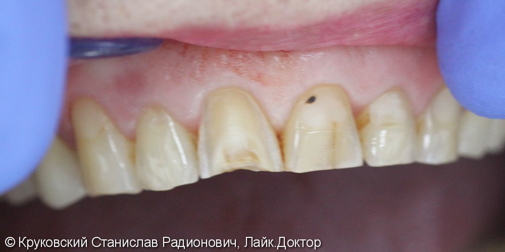 Эстетическая реставрация двух передних зубов 11, 21, до и после - фото №1