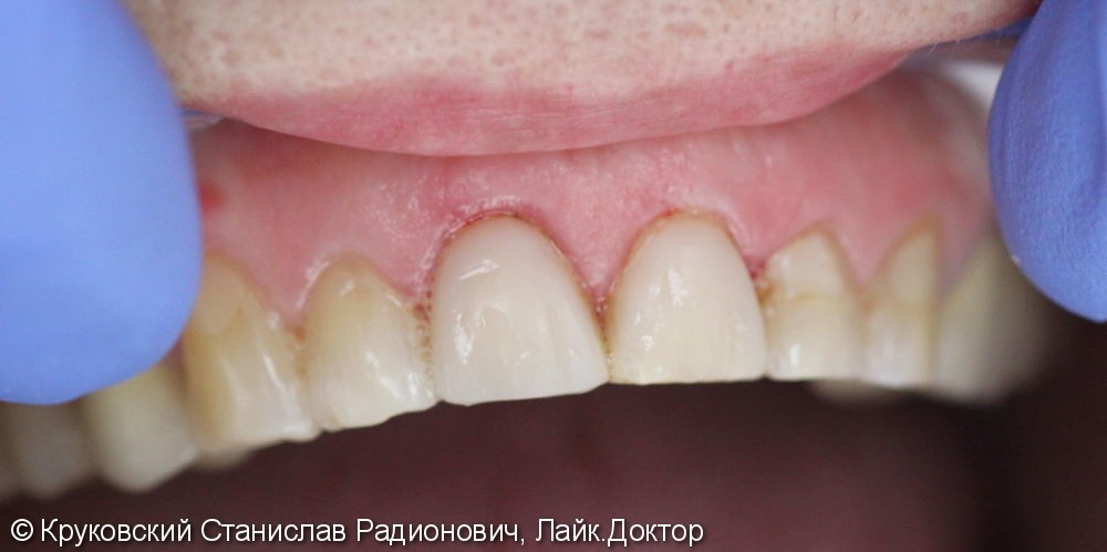 Эстетическая реставрация двух передних зубов 11, 21, до и после - фото №2
