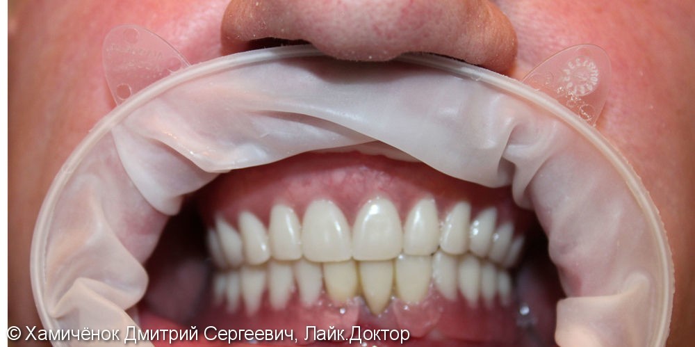 Полная адентия зубов верхней челюсти, частичная адентия зубов нижней челюсти, до и после лечения - фото №2