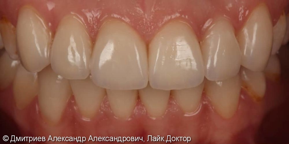 Коронки E.мах на передние зубы - фото №2