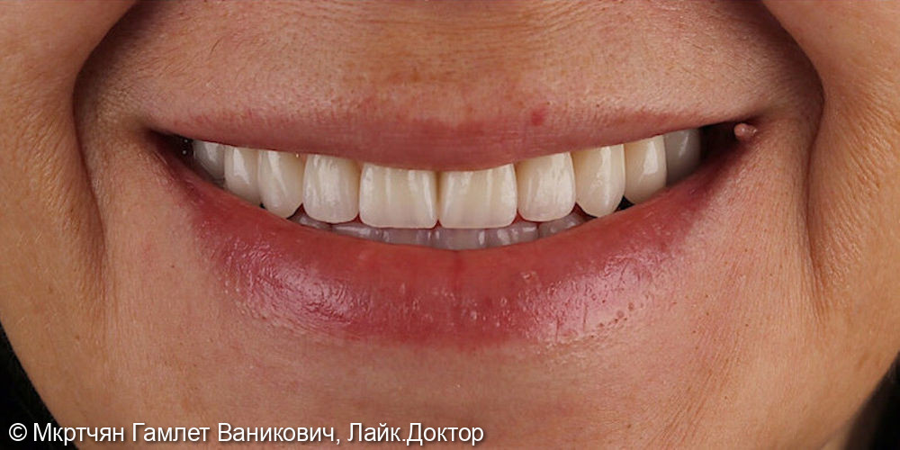 Тотальное восстановление зубных рядов по технологии All-on-6 - фото №1