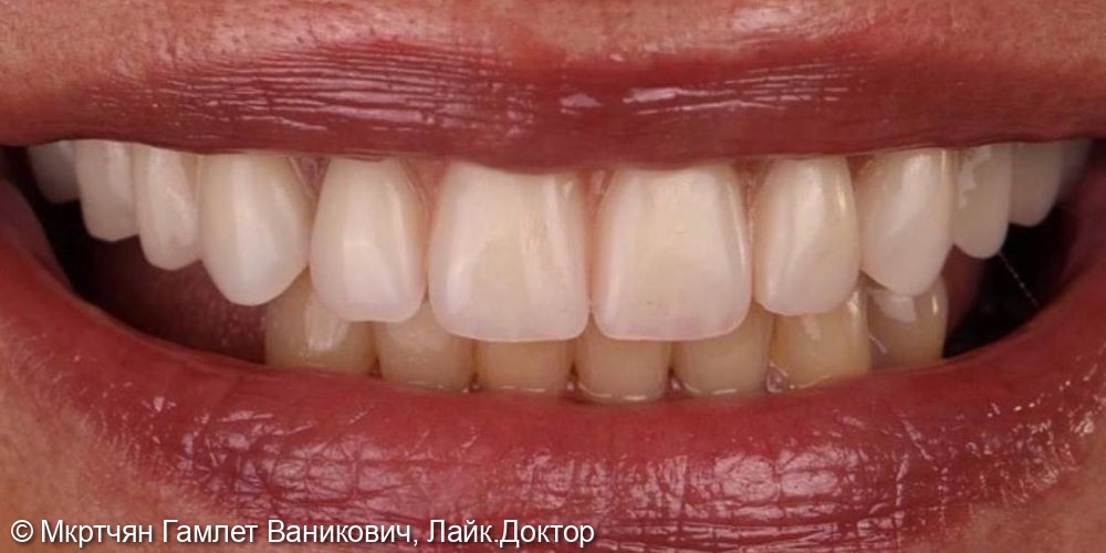 Тотальное восстановление зубов верхней челюсти на 6 имплантах (All-on-6) - фото №1