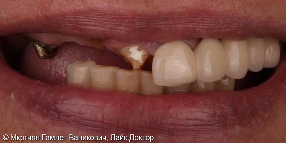 Тотальное восстановление зубов верхней челюсти на 6 имплантах (All-on-6) - фото №2
