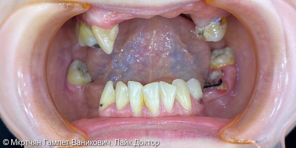 Комплексная реабилитация зубных рядов верхней и нижней челюстей - фото №2
