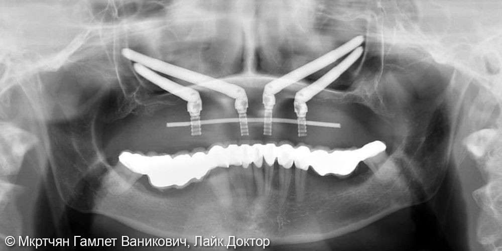 Комплексная реабилитация зубных рядов верхней и нижней челюстей - фото №3