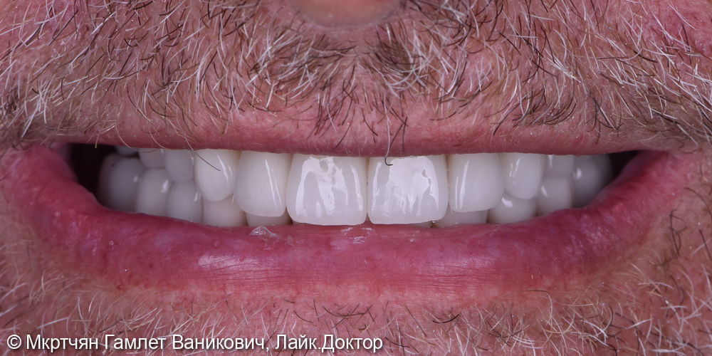 Восстановление всех зубов - фото №1