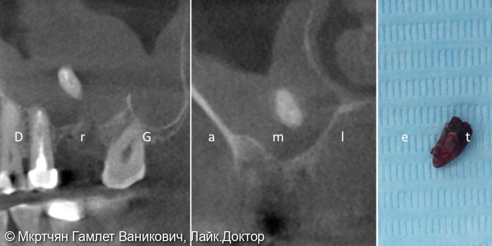 Удаление корня зуба из верхнечелюстной (гайморовой) пазухи - фото №1